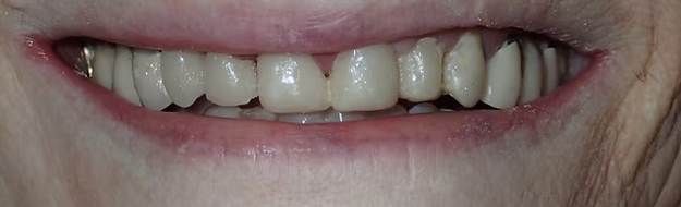 Case 1 after treatment: restored front teeth, cropped around the mouth