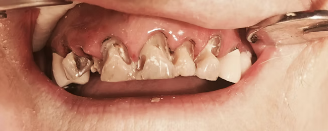 Case 1 before treatment: damaged front teeth
