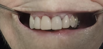 Case 2 after restorative dental treatment: front teeth