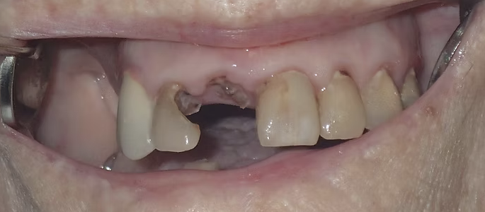Case 2 before treatment: severely damaged teeth